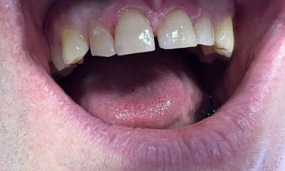 Fillings-After-Image