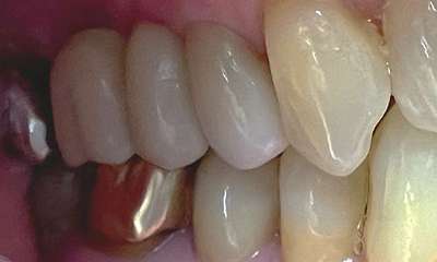 Implant crowns fully restored