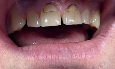 Fillings-Before-Image